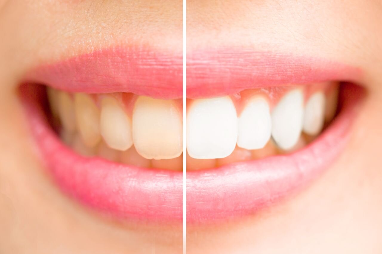 Dentystyka estetyczna czy leczenie? Implanty zębów i porcelanowe licówki